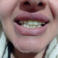 تخفیف فصلی کامپوزیت (1/500ت).عصب کشی در ایرانمهر|خدمات آرایشگری و زیبایی|یاسوج, |دیوار