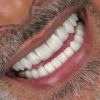 ساخت دندان مصنوعی قیمت ۸ الی ۱۵تومن ژاپنی وایتالیا