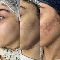 رفع تخصصی جای جوش|خدمات آرایشگری و زیبایی|تهران, قبا|دیوار