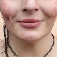 پیرسینگ میکرودرمال چالگونه