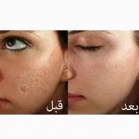 بوتاکس و مزوتراپی میکرونیدلینگ جای جوش و آموزش|خدمات آموزشی|شوش, |دیوار