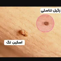 زگیل تناسلی|خدمات آرایشگری و زیبایی|تبریز, |دیوار