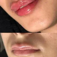 ژل،بوتاکس، لیزرخال و تاتو،ریمور