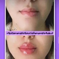 ژل لب فیلر بادی لیزر هایفو فیشال اقساطی بدون پیش
