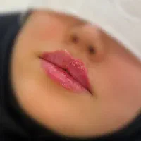 تزریق ژل وبوتاکس|خدمات آرایشگری و زیبایی|قم, بکایی|دیوار