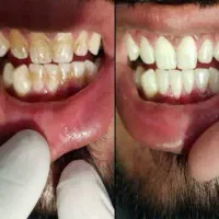 جرمگیری دندان تقریبا رایگان|خدمات آرایشگری و زیبایی|بیرجند, |دیوار