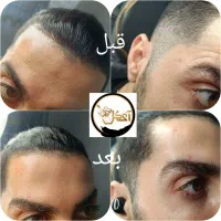 تزریق ژل،بوتاکس،آنزیم،پی آر پی، مزو ژل برای آقایان|خدمات آرایشگری و زیبایی|خرمشهر, |دیوار