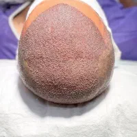 کاشت مو/کاشتمو/کاشت ابرو/کاشت ریش یک مرحله|خدمات آرایشگری و زیبایی|نجف‌آباد, باغ ملی|دیوار