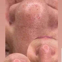 فیشال تخصصی با درماپلنینگ (تضمینی )