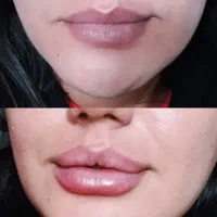 تزریق ژل لب.گونه.چانه.زاویه سازی فک.آنزیم بینی|خدمات آرایشگری و زیبایی|اردکان, |دیوار