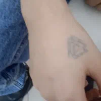 پاک کردن تتو با لیزر کیوسویچ در مطب