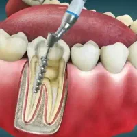 دندانپزشکی ، عصب کشی،ترمیم،کشیدن روکش
