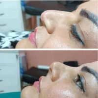 فرم دهی و زیبایی بینی