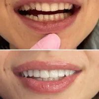 جشنواره کامپوزیت 8000 م ،عصب کشی از۲۵۰۰ توسط پزشک|خدمات آرایشگری و زیبایی|رشت, دروازه لاکان|دیوار