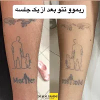 ریمو،پاک کردن تتو،ریموو تتو ابرو با لیزر توسط پزشک|خدمات آرایشگری و زیبایی|شیراز, پانصد دستگاه ارتش|دیوار