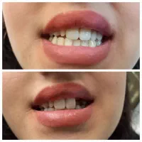 دندانسازی پروتز متحرک دندان مصنوعی دندان ساز