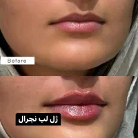 آف تزریق ژل وبوتاکس ومزوژل جوانساز|خدمات آرایشگری و زیبایی|آمل, |دیوار