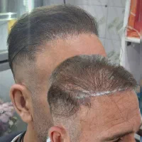 میکرواسکالپ / مکمل کاشت مو|خدمات آرایشگری و زیبایی|دوگنبدان, |دیوار