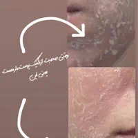 فیشال،آلگاپیل(پوست مار)هایفوتراپی،پوست کره ای|خدمات آرایشگری و زیبایی|قم, دورشهر|دیوار