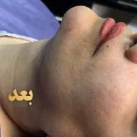 ساکشن غبغب  زاویه‌سازی فک و صورت . دکتر واحدی