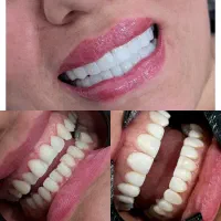 کامپوزیت دندان با برندهای معتبر جهانی|خدمات آرایشگری و زیبایی|اهواز, نادری|دیوار