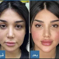 ٪50 آفر مزو prp بوتاکس فیلر لب زاویه سازی فیلرچانه