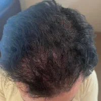 درمان ریزش مو با مزوتراپی توسط پزشک