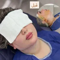 ساکشن غب غب،بوکال فت،سانترال لب