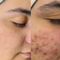 لک جای جوش اکنه پی ار پی prp مو مزونیدلینگ سابسیژن