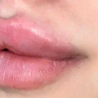 تزریق ژل و بوتاکس،۴سال سابقه زیبایی