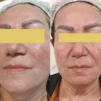 پکیج جوانسازی،هایفوصورت،واژینال،درمان تیرگی،بوتاکس