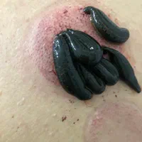 حجامت و زالو و بادکش