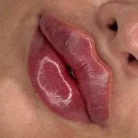 جشنواره تزریق ژل بوتاکس فیلر پی آرپی مطب زیبایی