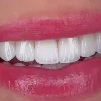 عصبکشی روکش کامپوزیت دندانپزشکی تهرانسر یافت آباد