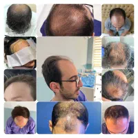 کاشت مو طبیعی  قیمت استثنایی مشاوره و اسکن رایگان