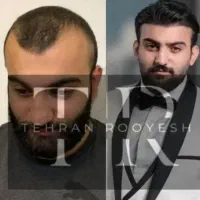 جشنواره کاشت مو ، ابرو و ریش ( ۴۰ ٪ تخفیف)