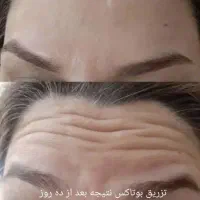 کلینیک تزریق ژل فیلر بوتاکس پی‌آر‌پی مزونیدلینگ