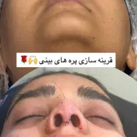 جشنواره ویژه جراحی بینی رینوپلاستی قیمت استثنایی|خدمات آرایشگری و زیبایی|جوانرود, |دیوار