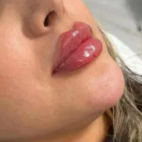 تزریق ژل با آف ویژه مخصوص این هفته