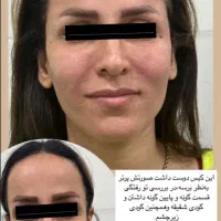 تزریق ژل و بوتاکس و پی ارپی و مزوتراپی و لیزر مو|خدمات آرایشگری و زیبایی|بوشهر, |دیوار