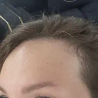 کاشت مو پیشانی خانم ها