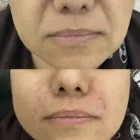 تخفیفات بزرگژل وبوتاکس در مشهد|خدمات آرایشگری و زیبایی|مشهد, کوثر|دیوار
