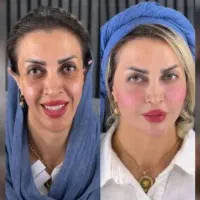 تزریق ژل لب و گونه و چانه.. (جشنواره)درمطب فقط499ت|خدمات آرایشگری و زیبایی|اصفهان, باغ زیار|دیوار