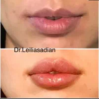 تزریق فیلر (ژل ) لیفت با نخ بوتاکس مزوتراپی|خدمات آرایشگری و زیبایی|مشهد, کوثر|دیوار