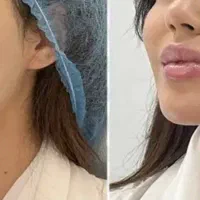 تخفیف ویژه فیلربوتاکس و مزوژل ها