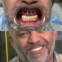 ایمپلنت دیجیتال|خدمات آرایشگری و زیبایی|قم, نیروگاه|دیوار