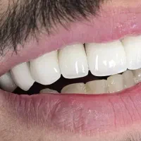 ساخت روکش دندان در دانشکده دندانپزشکی