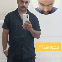 کاشت مو با ضمانت تراکم و خط رویش