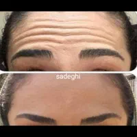 ژل وبوتاکس.چربی سوز.انزیم.فشیال.پیرسینگ|خدمات آرایشگری و زیبایی|اصفهان, احمدآباد|دیوار