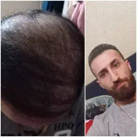 کاشت  دائمی مو بدون درد و خونریزی